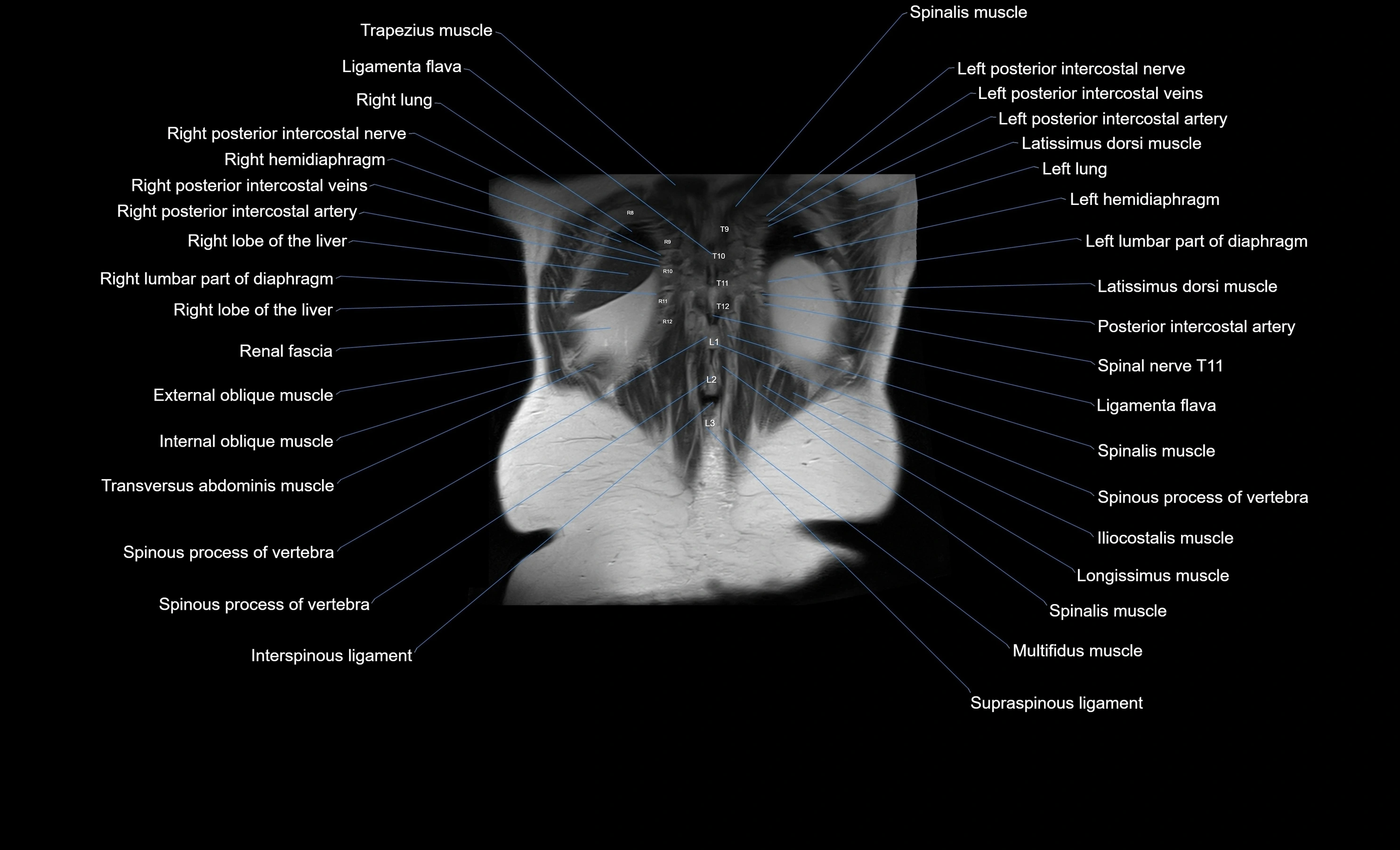 MRI Abdomen coronal labelled cross sectional anatomy radiology  image-img-00001-00052.webp